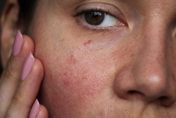 Sensitive Skin Solutions: Finding the Right Moisturizer